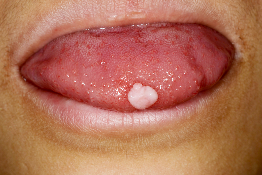 舌 線維腫